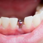 Qu'est-ce qu'une restauration complète de la bouche